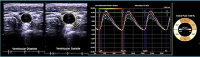 Characteristics of Carotid Artery Structure and Mechanical Function and Their Relationships with Aortopathy in Patients with Bicuspid Aortic Valves